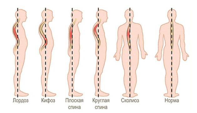 Лечение сколиоза и кифоза в Центрах доктора Бубновского